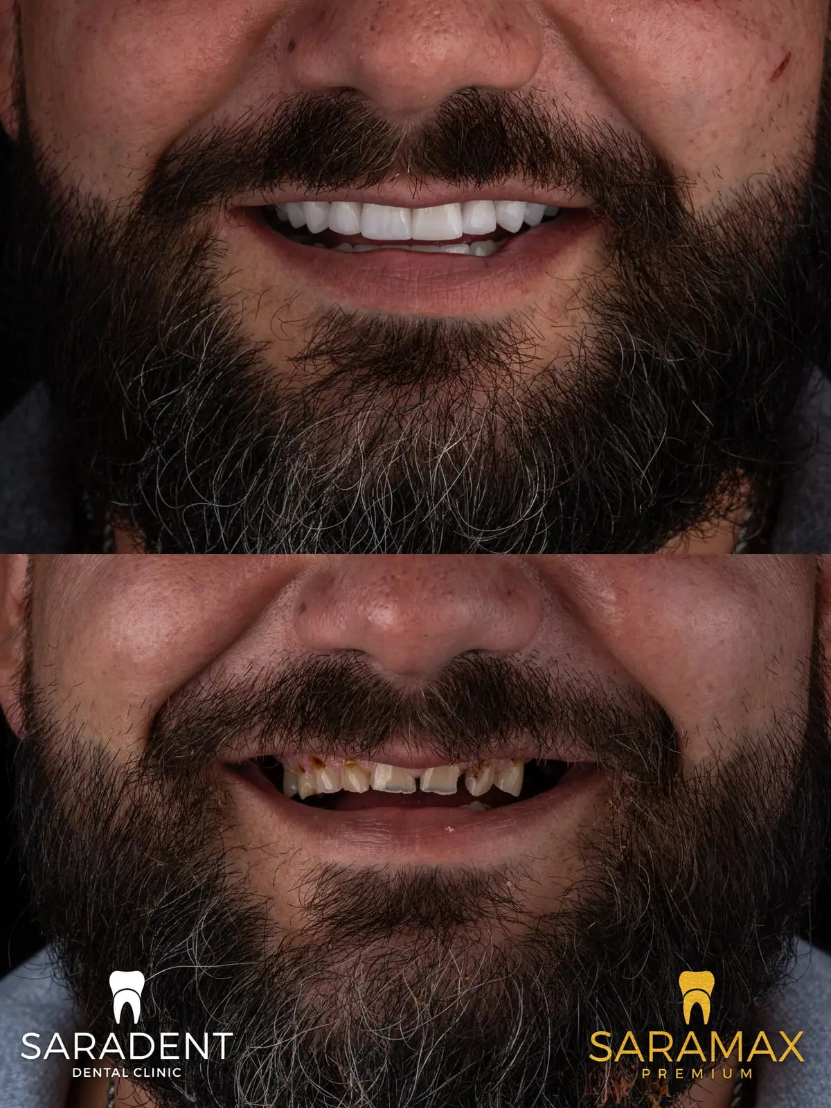 Close-up of the smile – after at the top, before at the bottom