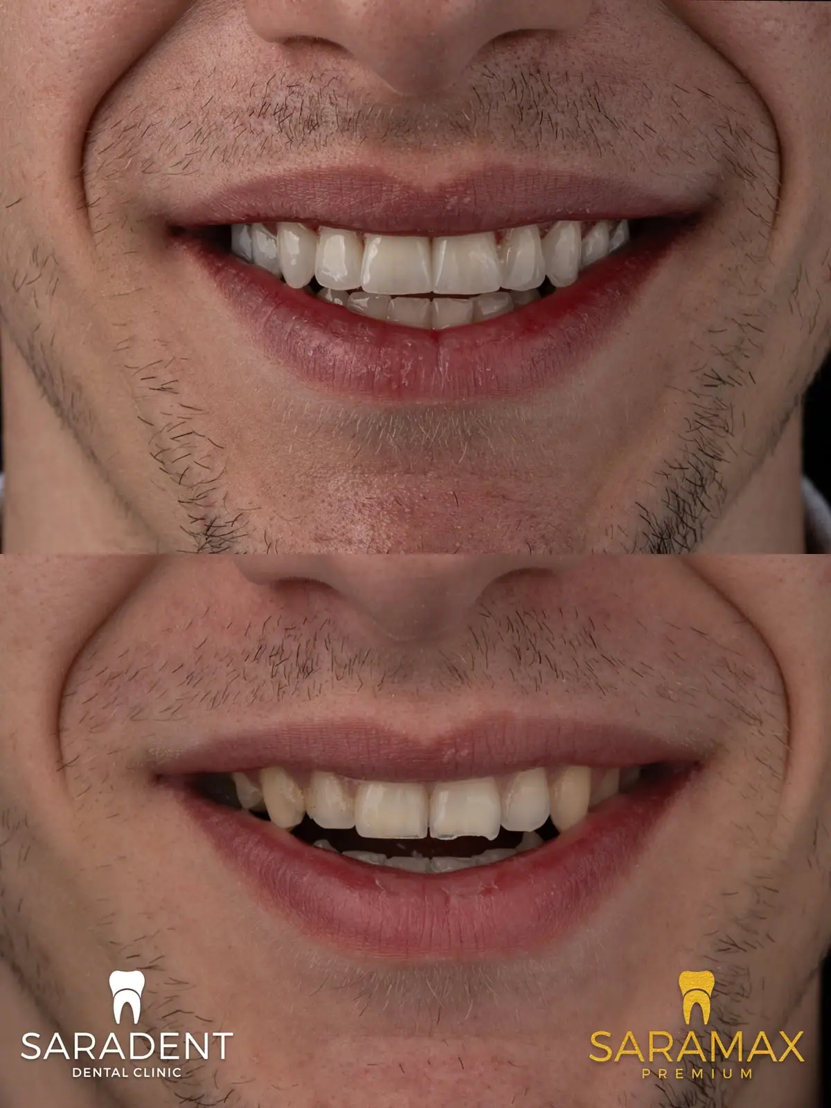 Close-up of the smile – after at the top; before at the bottom, with chipped front teeth