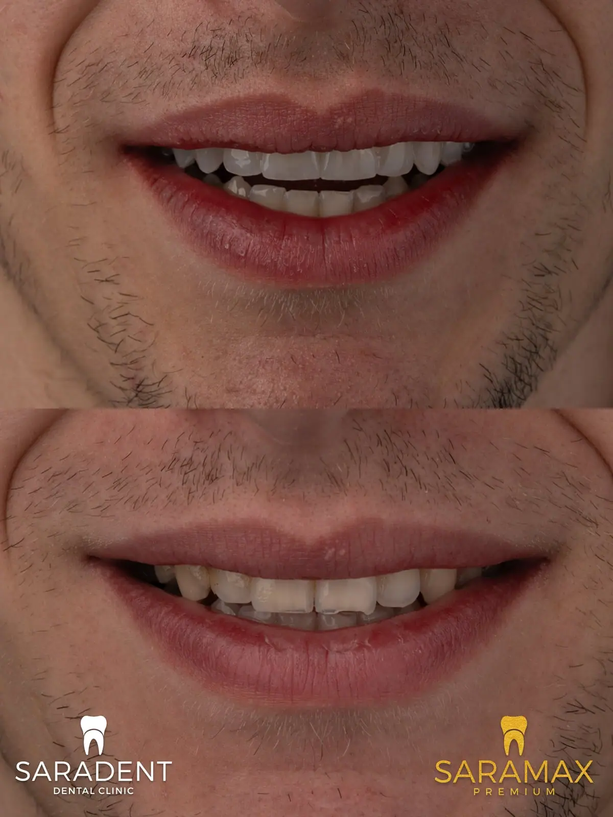 Close-up of the lips and teeth – after at the top, before at the bottom
