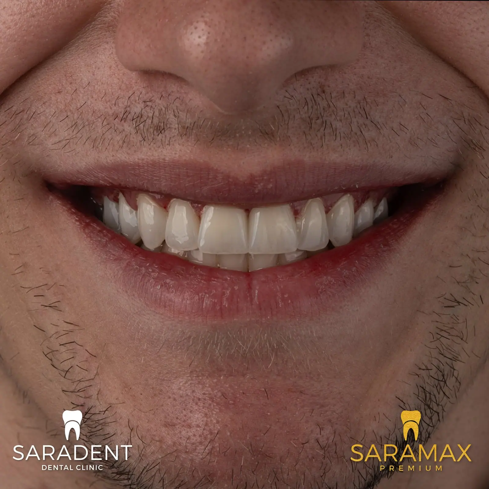 Krupni plan novih zuba nakon SaraMax Premium rada