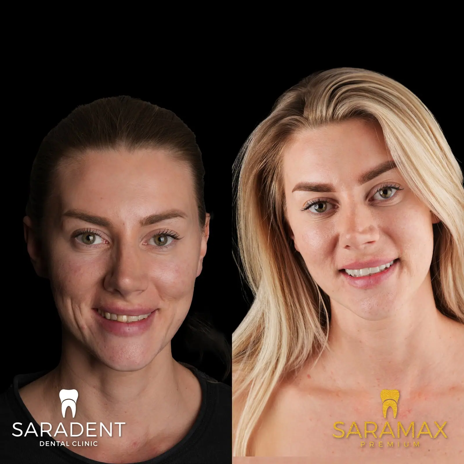 Woman before and after – before on the left; after on the right, with even, brighter teeth