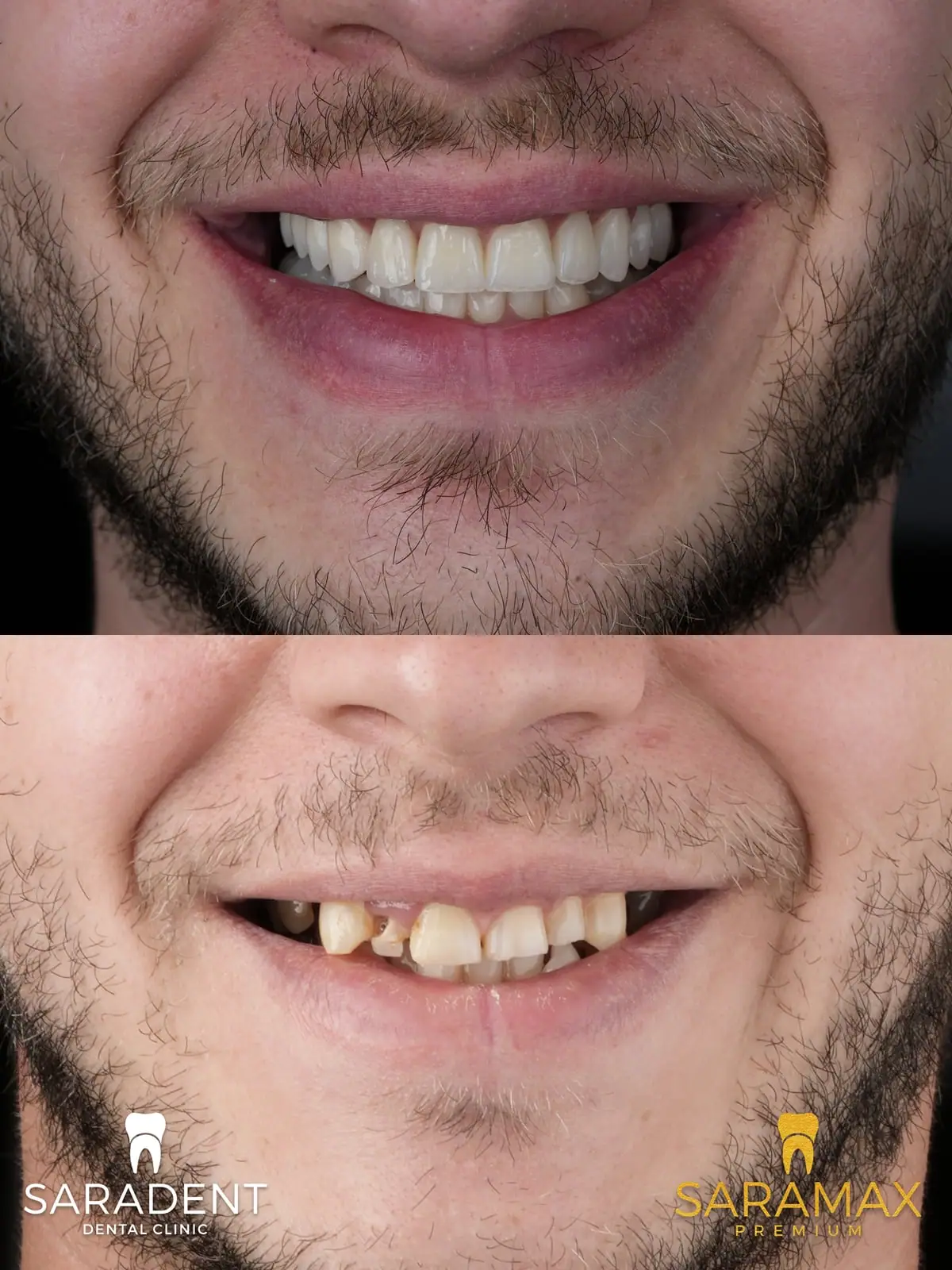 Close-up of a young man's smile – after at the top, before at the bottom
