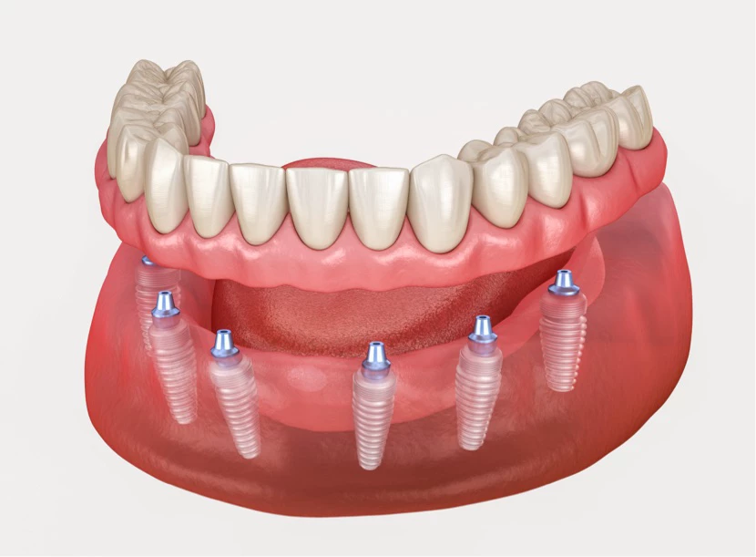 Izgled fiksne proteze koje je uradila stomatološka ordinacija Saradent iz Sarajeva