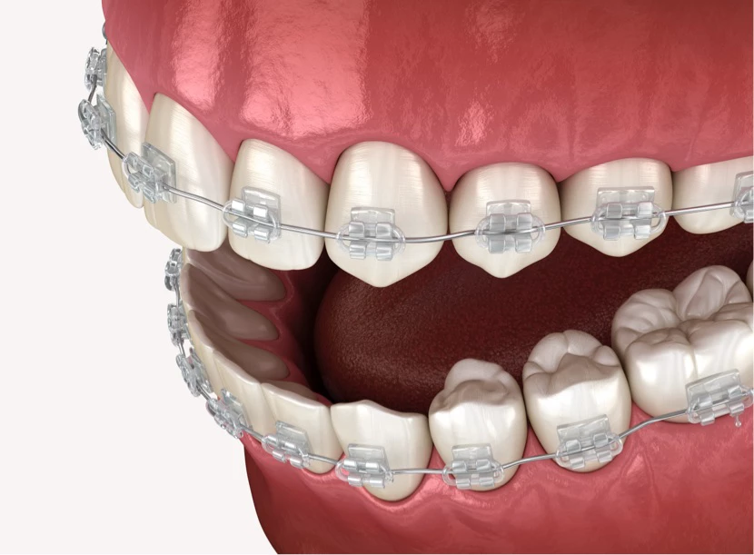 Ortodoncija izgled proteze koje je uradila stomatološka ordinacija Saradent iz Sarajeva